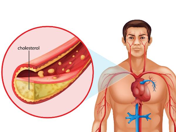 রক্তে কোলেস্টেরল  কমানোর উপায়